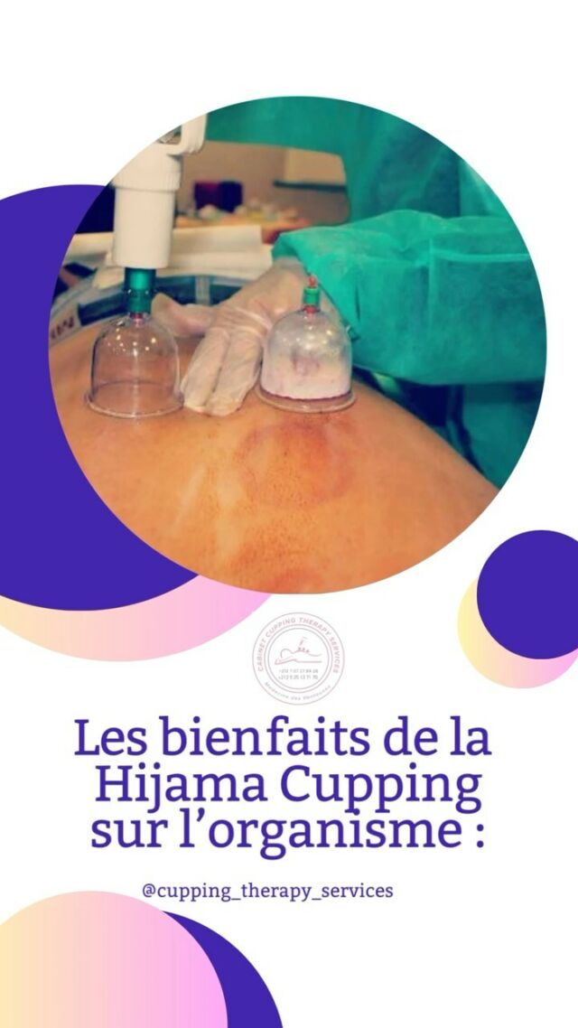 #cuppingtherapy #hijama #hijamah