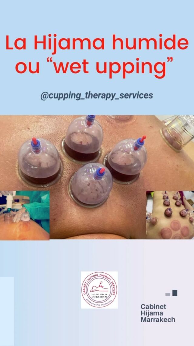 #hijama #hijamah #hijamatherapy #wellnes ✅ Ce qui ne peut pas être évacué naturellement par l'organisme constitue l’excédent”. ( souvent cet excédent où ces déchets viennent de notre mauvaise hygiène de vie, cigarette, alcool, malbouffe, manque d activité physique, surconsommation de médicaments 💊…). Cet excédent fini par se retrouver dans le sang et provoque ensuite des troubles voir des dysfonctionnements au niveau de notre santé. ✅ La Hijama agit comme une "détox externe” on extrait cet excédent pour laisser place à une meilleure circulation sanguine, une oxygénation des tissus et des muscles". ✅ La détox interne quand à elle se se fait par le fait d’adopter une bonne hygiène de vie alimentaire et physique.